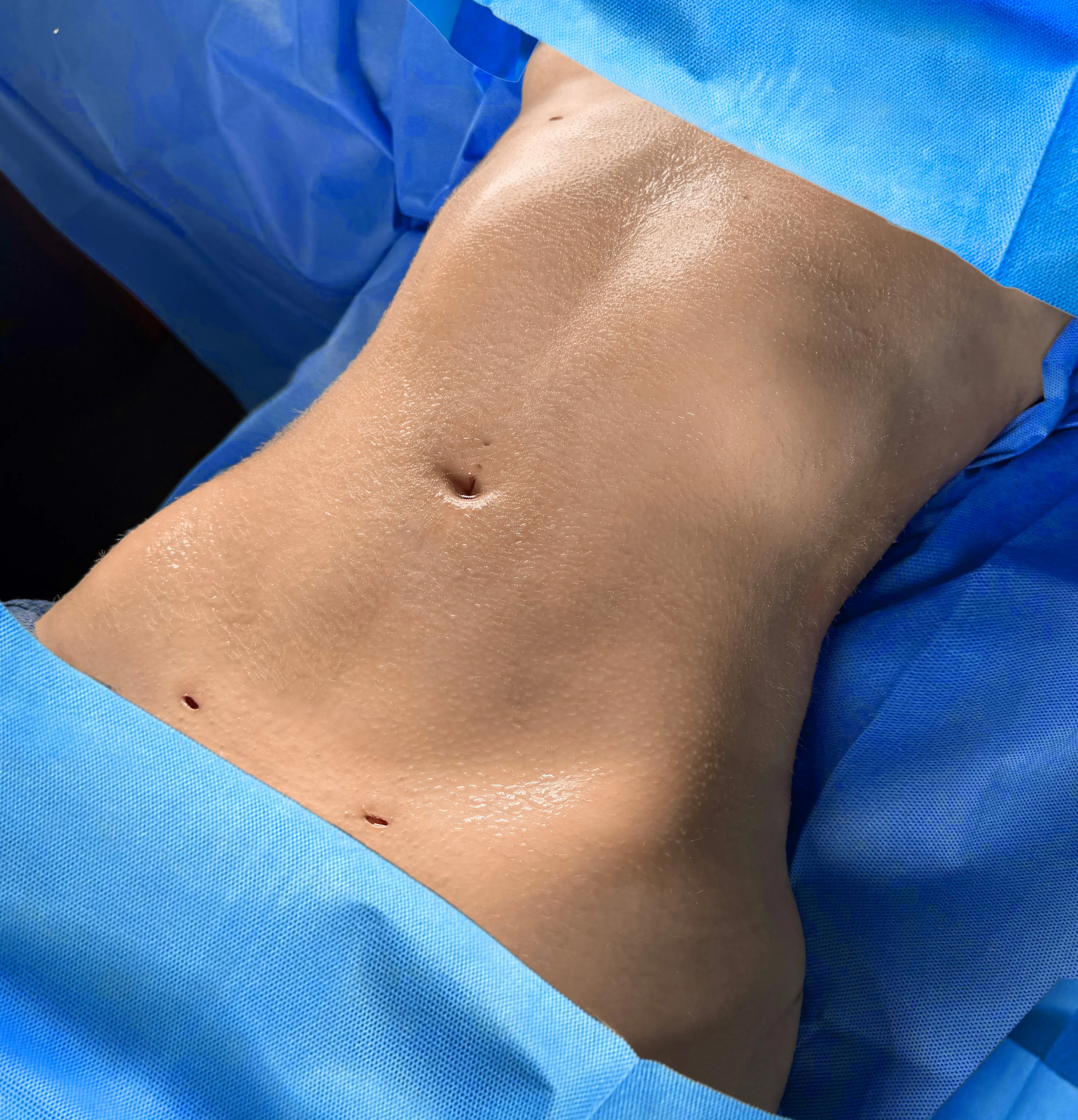 Liposuction & Lipo 360 after by Dr. Oliver Simmons in Miami · Beautyland Plastic Surgery
