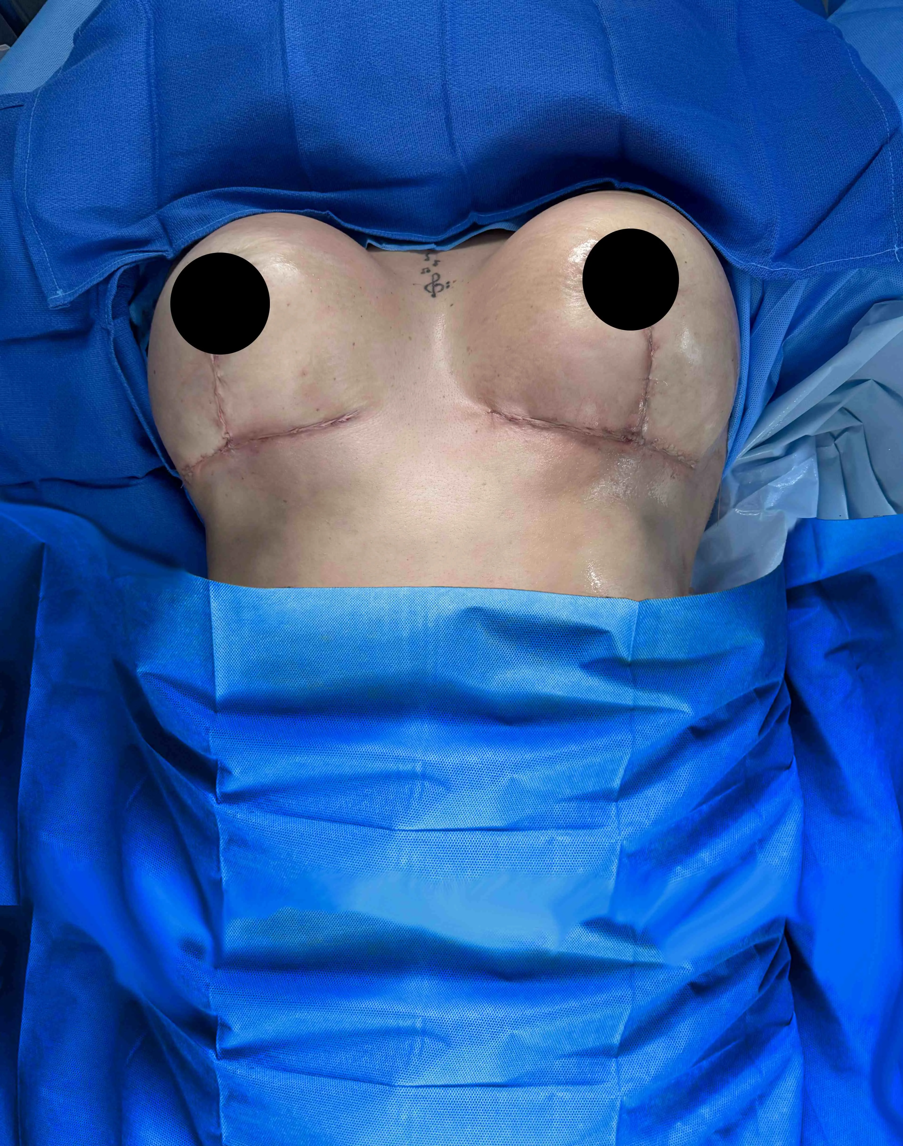 Breast Lift after by Dr. Oliver Simmons in Miami · Beautyland Plastic Surgery