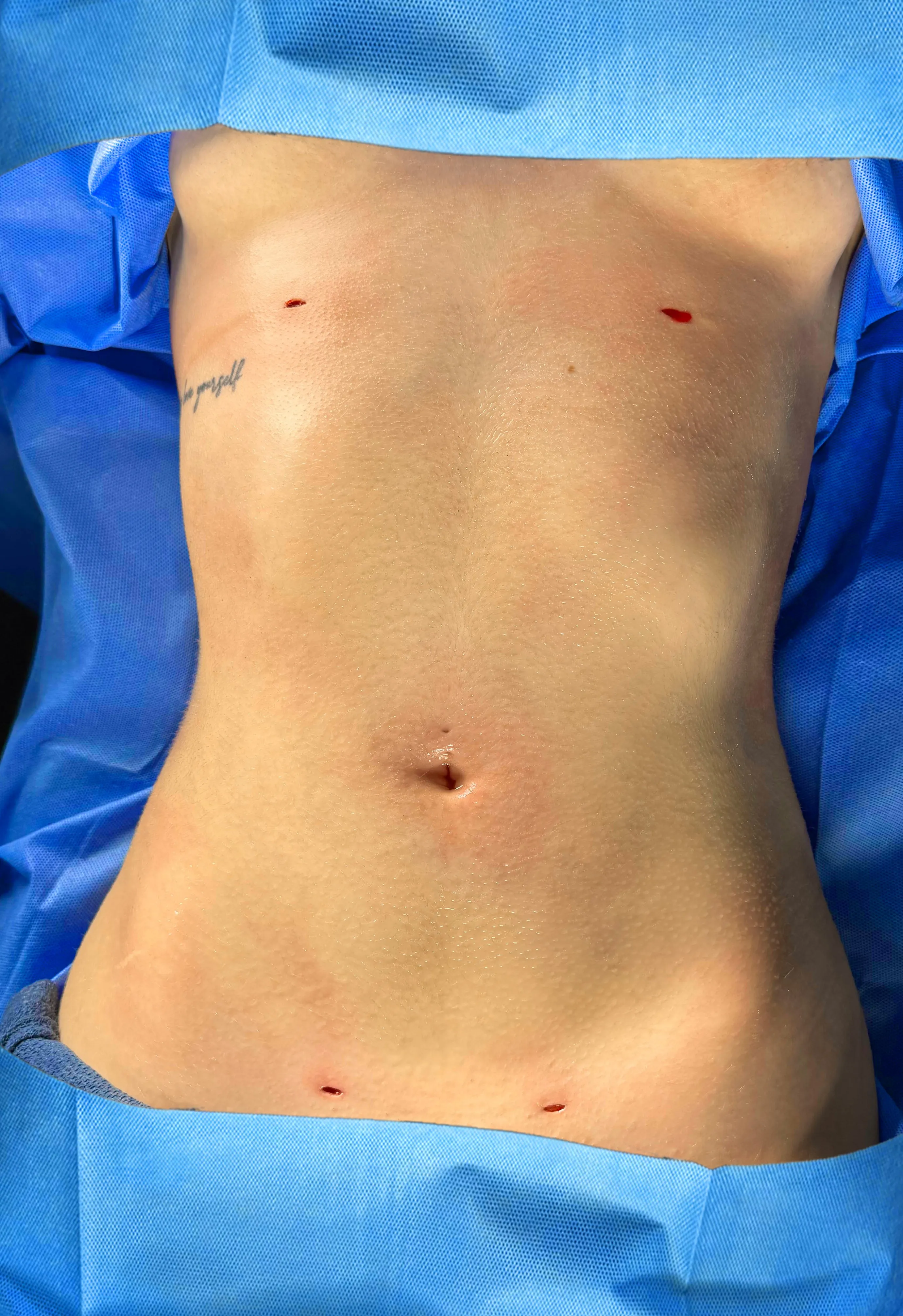 Liposuction & Lipo 360 after by Dr. Oliver Simmons in Miami · Beautyland Plastic Surgery