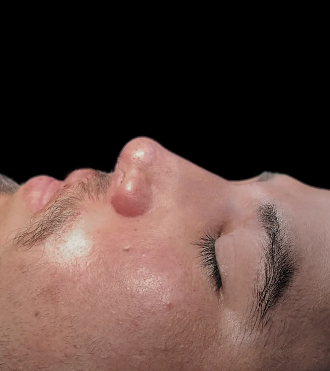 Rhinoplasty after by Dr. Oliver Simmons in Miami · Beautyland Plastic Surgery