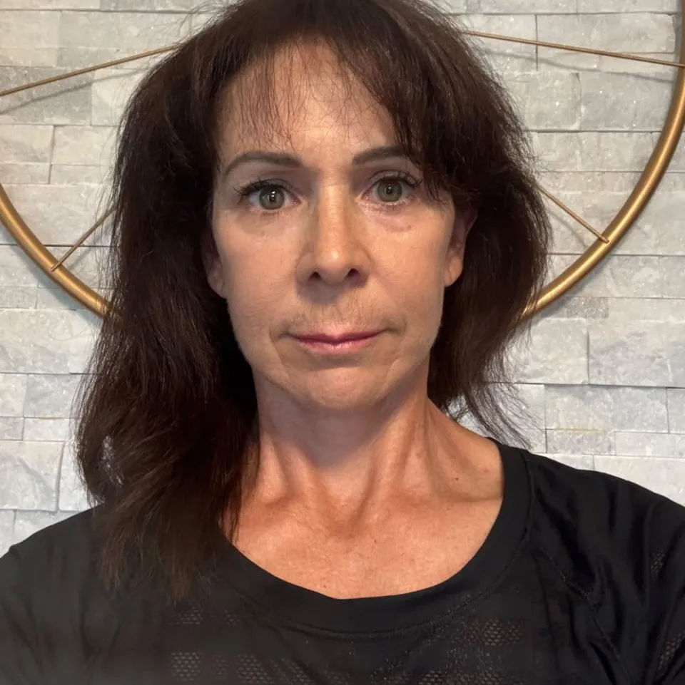 Rostro y cuello después por Dr. Oliver Simmons en Miami · Beautyland Plastic Surgery