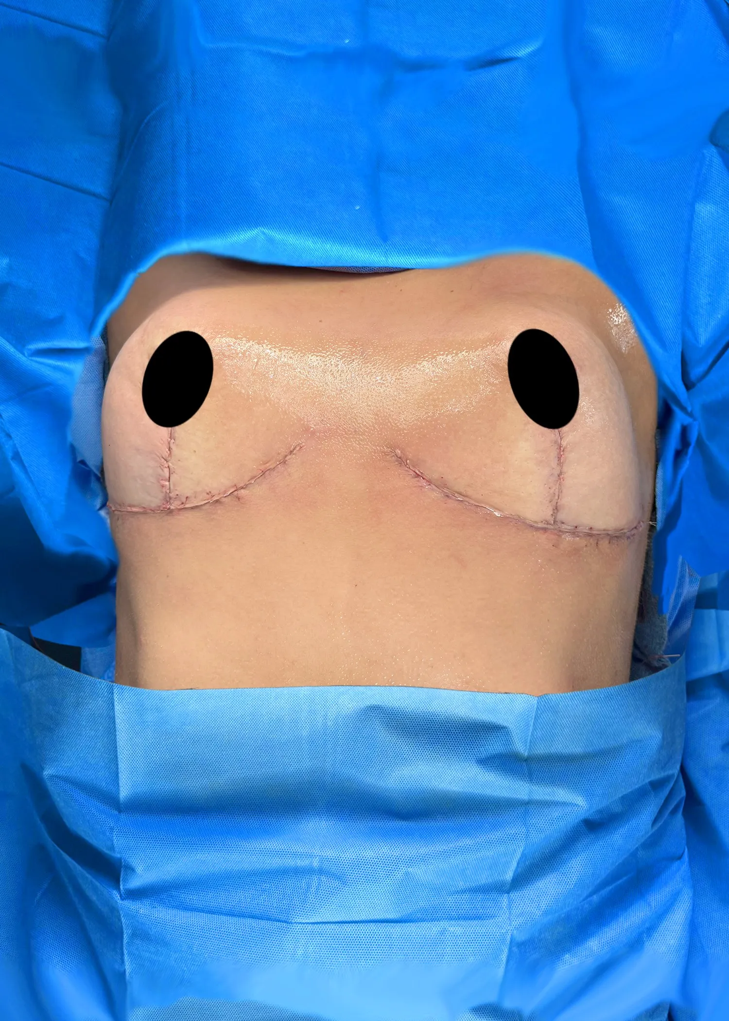 Breast Lift after by Dr. Oliver Simmons in Miami · Beautyland Plastic Surgery