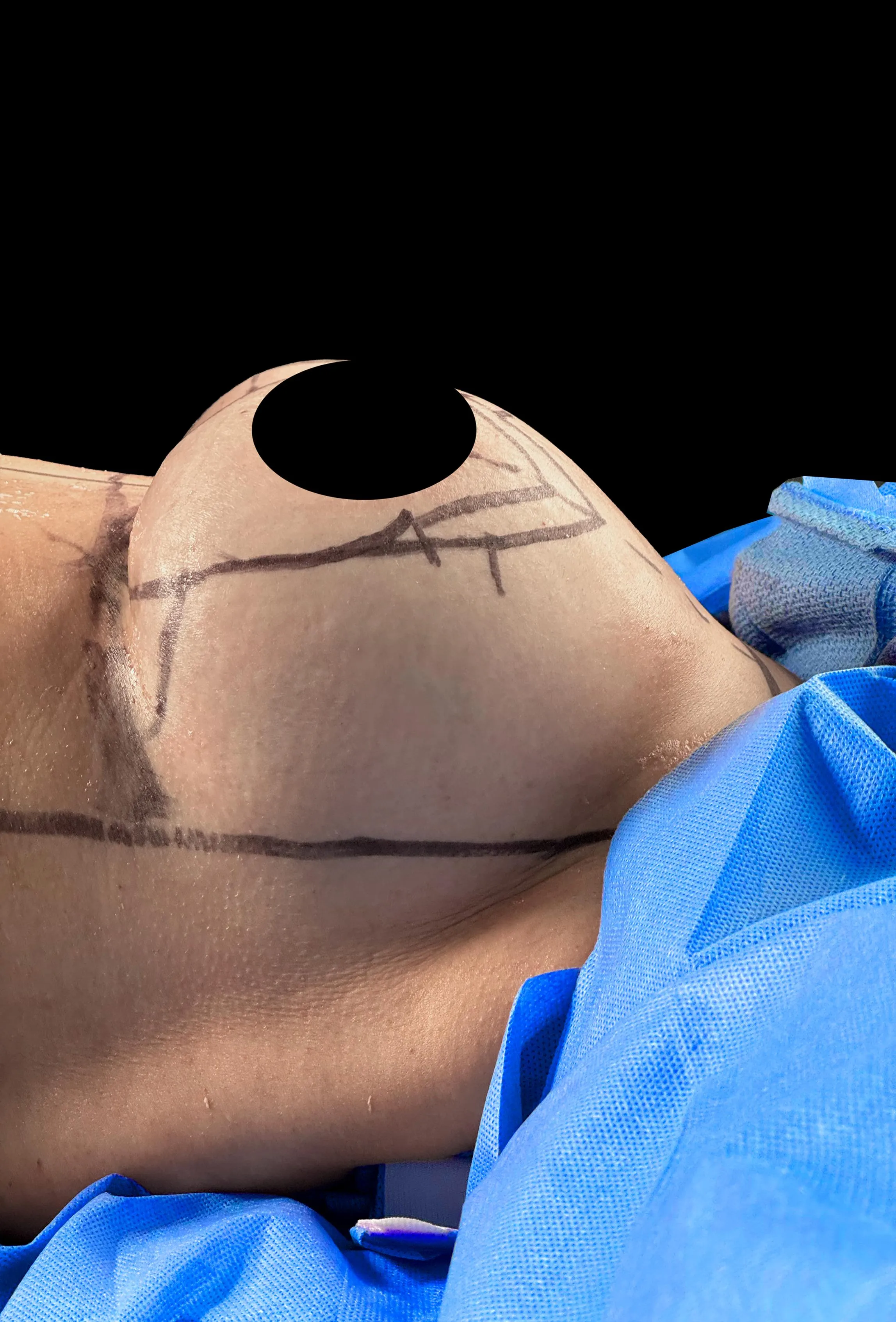 Breast Lift before by Dr. Anne-Sophie Lessard in Miami · Beautyland Plastic Surgery