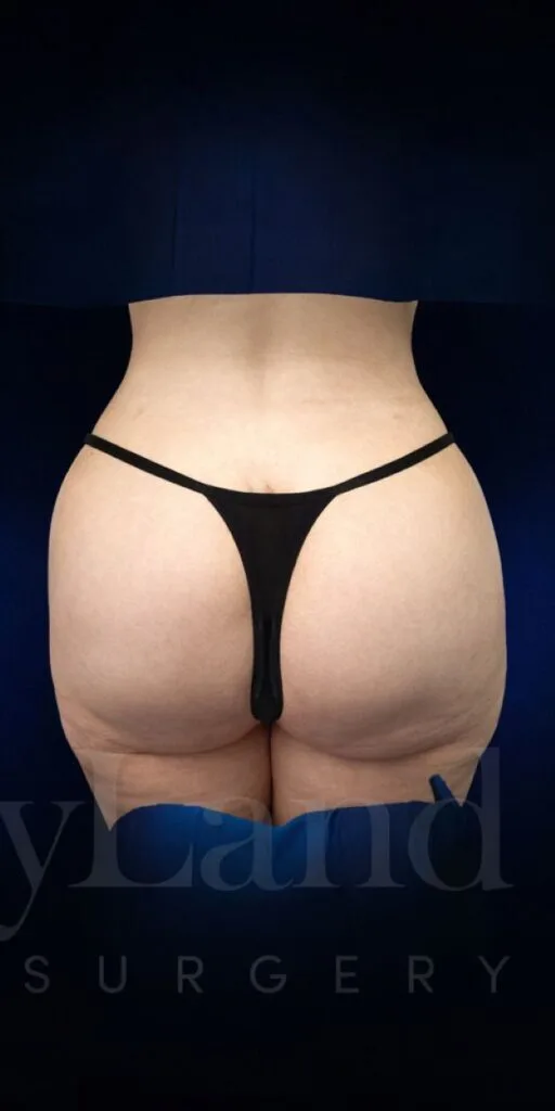 Implantes de glúteos después por Dr. Christopher J. Salgado en Miami · Beautyland Plastic Surgery