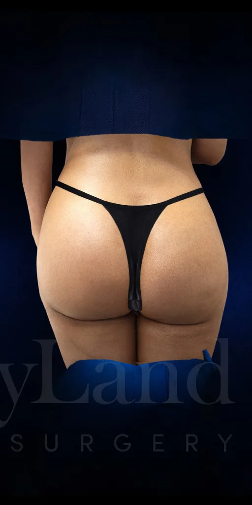 Implantes de glúteos después por Dr. Christopher J. Salgado en Miami · Beautyland Plastic Surgery