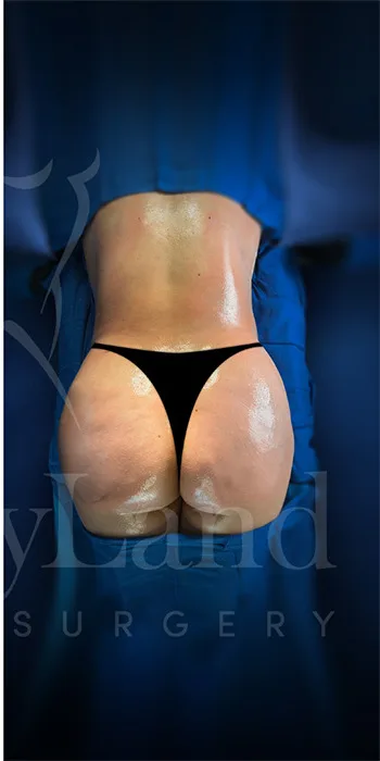 Aumento de glúteos BBL después por Dr. Oliver Simmons en Miami · Beautyland Plastic Surgery