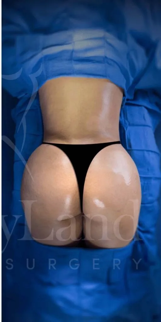 Aumento de glúteos BBL después por Dr. Oliver Simmons en Miami · Beautyland Plastic Surgery