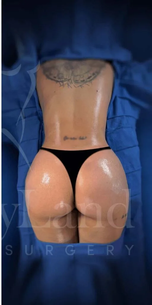 Aumento de glúteos BBL después por Dr. Oliver Simmons en Miami · Beautyland Plastic Surgery