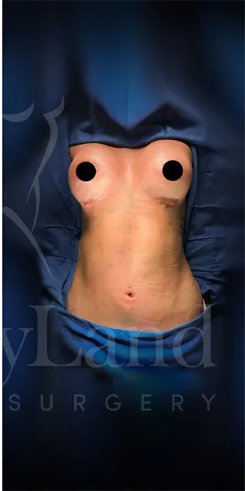 Aumento de senos después por Dr. Oliver Simmons en Miami · Beautyland Plastic Surgery