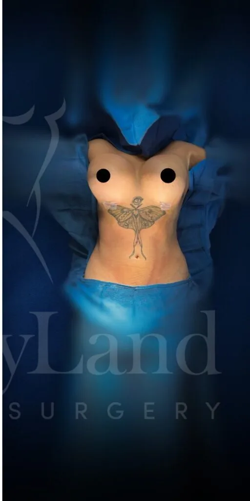 Aumento de senos después por Dr. Oliver Simmons en Miami · Beautyland Plastic Surgery