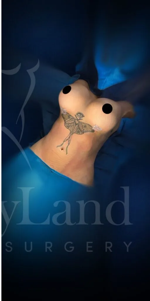 Aumento de senos después por Dr. Oliver Simmons en Miami · Beautyland Plastic Surgery