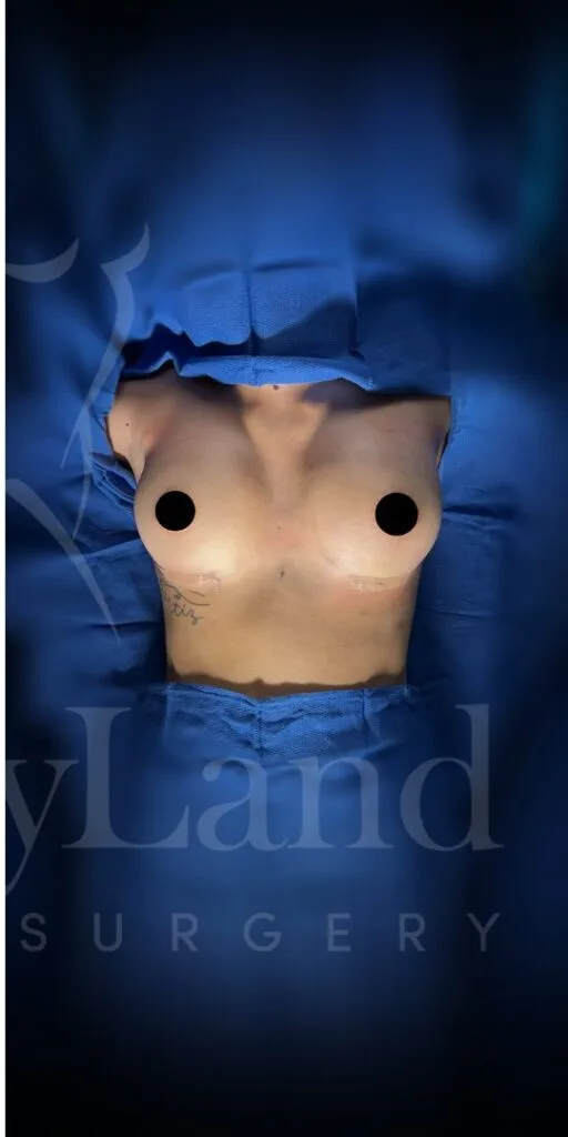 Aumento de senos después por Dr. Oliver Simmons en Miami · Beautyland Plastic Surgery
