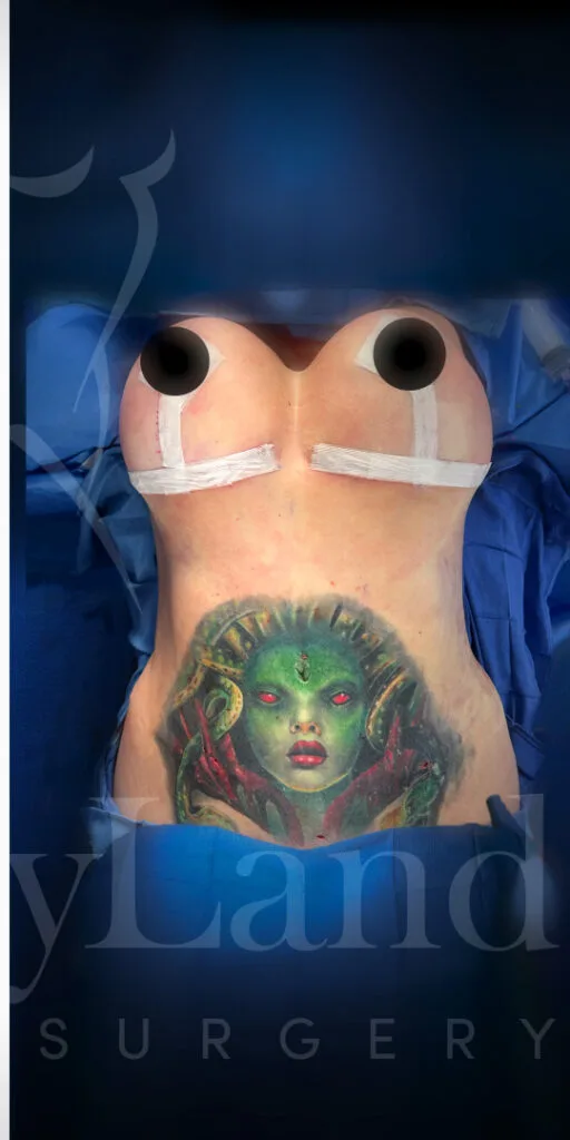 Mastopexia (elevación de senos) después por Dr. Oliver Simmons en Miami · Beautyland Plastic Surgery