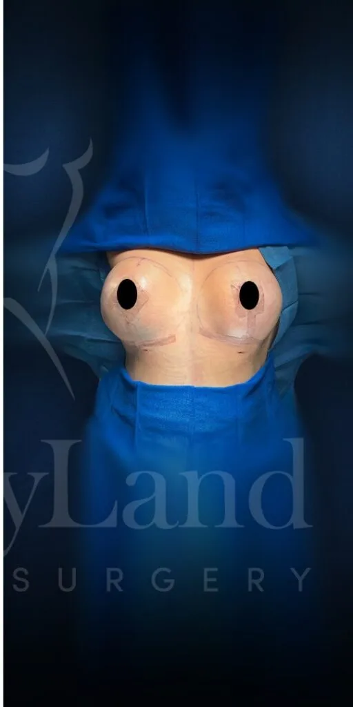 Mastopexia (elevación de senos) después por Dr. Oliver Simmons en Miami · Beautyland Plastic Surgery