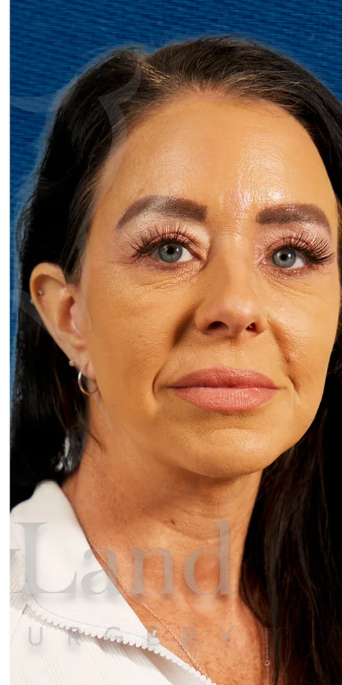 Lifting facial después por Dr. Oliver Simmons en Miami · Beautyland Plastic Surgery