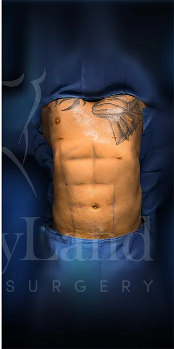 Liposucción y Lipo 360 después por Dr. Oliver Simmons en Miami · Beautyland Plastic Surgery