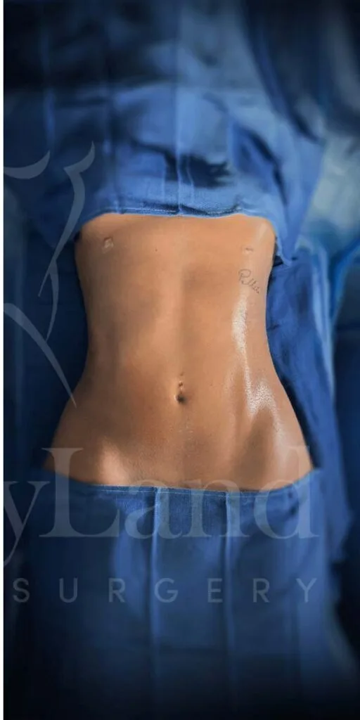 Liposucción y Lipo 360 después por Dr. Oliver Simmons en Miami · Beautyland Plastic Surgery