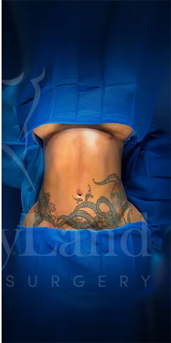Liposucción y Lipo 360 después por Dr. Oliver Simmons en Miami · Beautyland Plastic Surgery