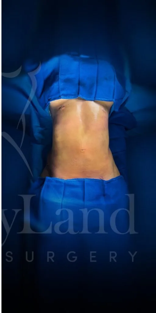 Liposucción y Lipo 360 después por Dr. Oliver Simmons en Miami · Beautyland Plastic Surgery