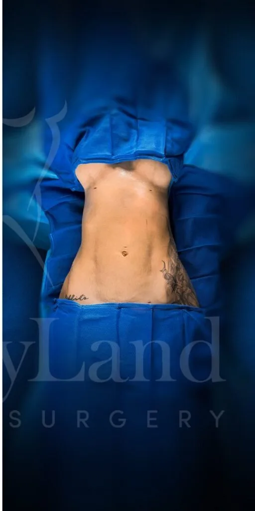 Liposucción y Lipo 360 después por Dr. Oliver Simmons en Miami · Beautyland Plastic Surgery