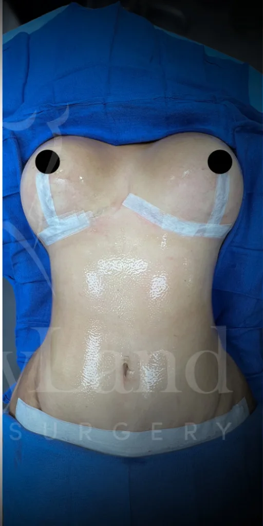 Abdominoplastia después por Dr. Oliver Simmons en Miami · Beautyland Plastic Surgery