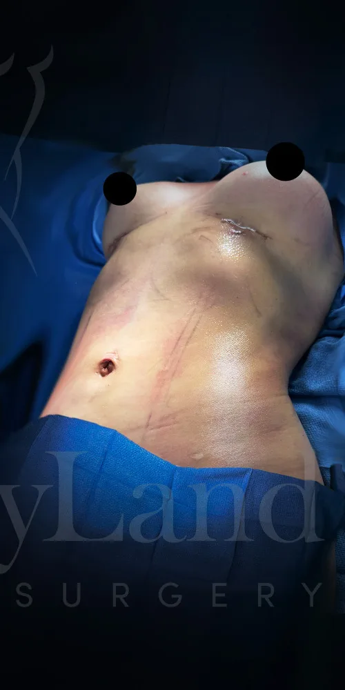 Abdominoplastia después por Dr. Oliver Simmons en Miami · Beautyland Plastic Surgery