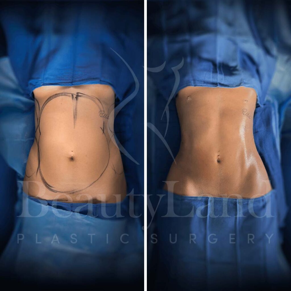 Liposuction