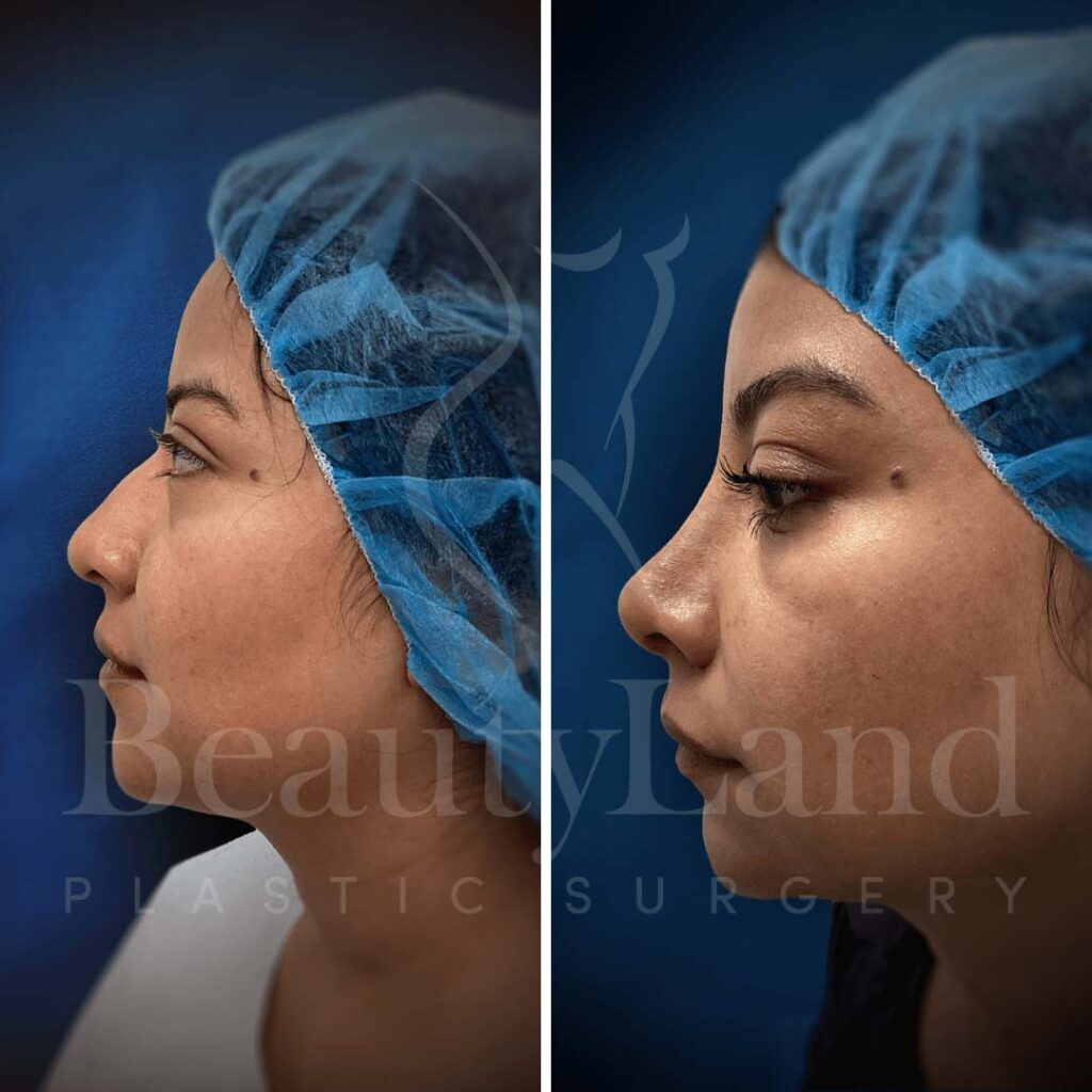 Rhinoplasty