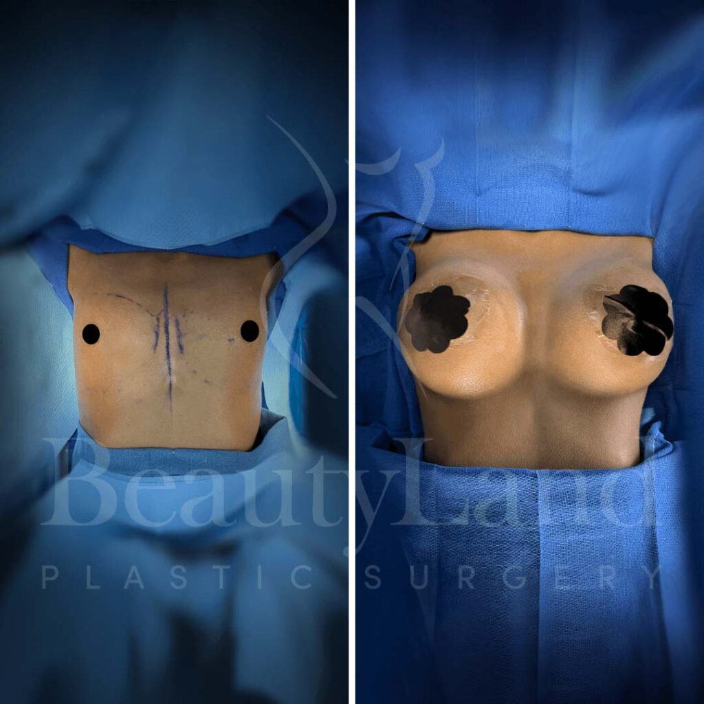 Breast Augmentation