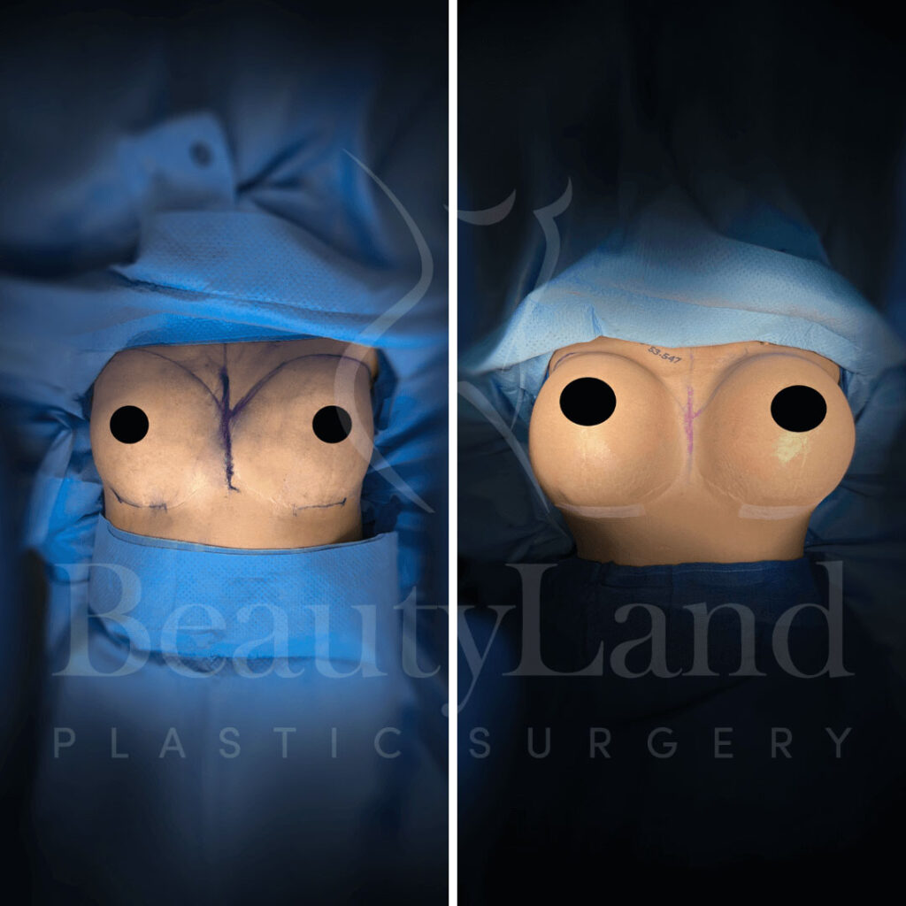 Breast Augmentation