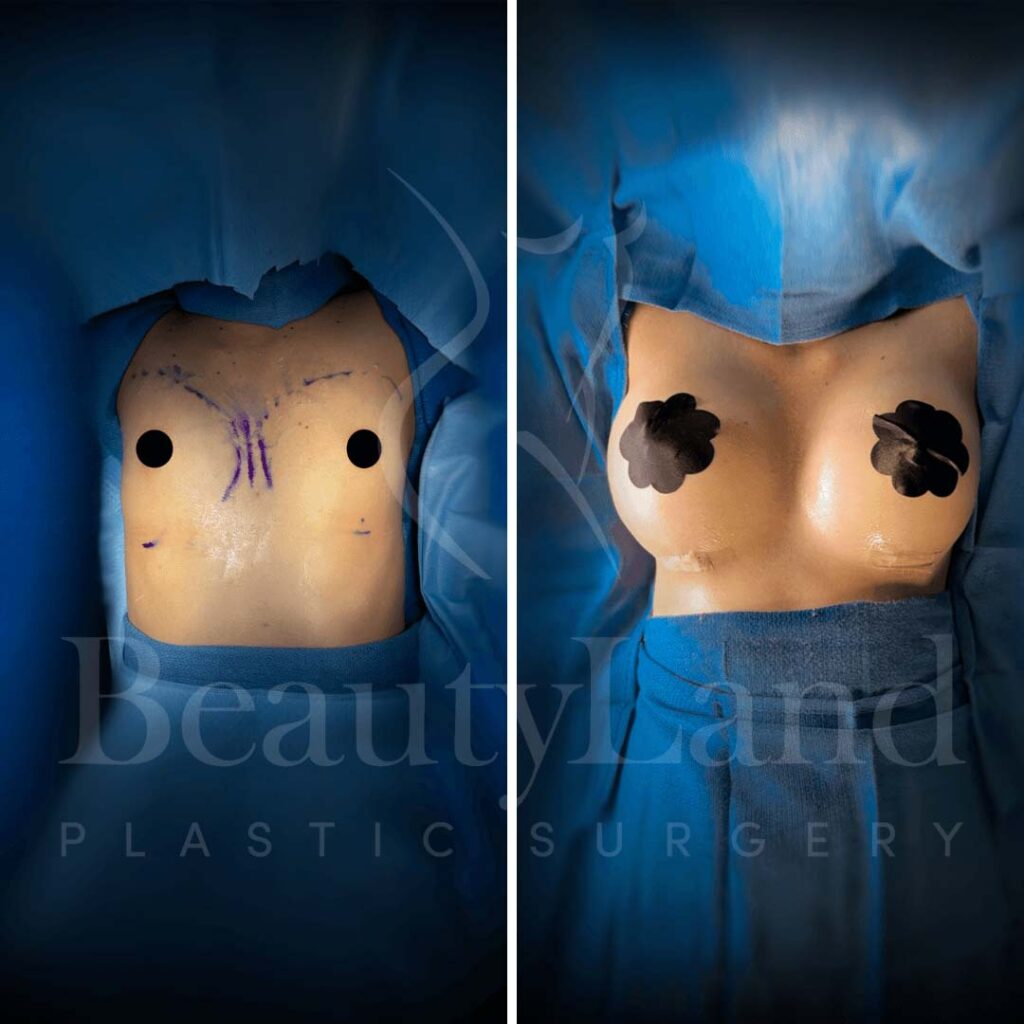 Breast Augmentation