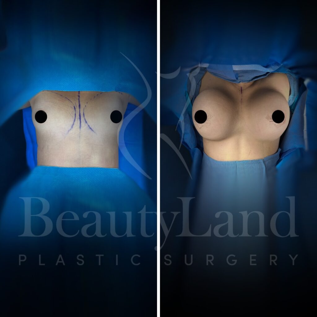 Breast Augmentation