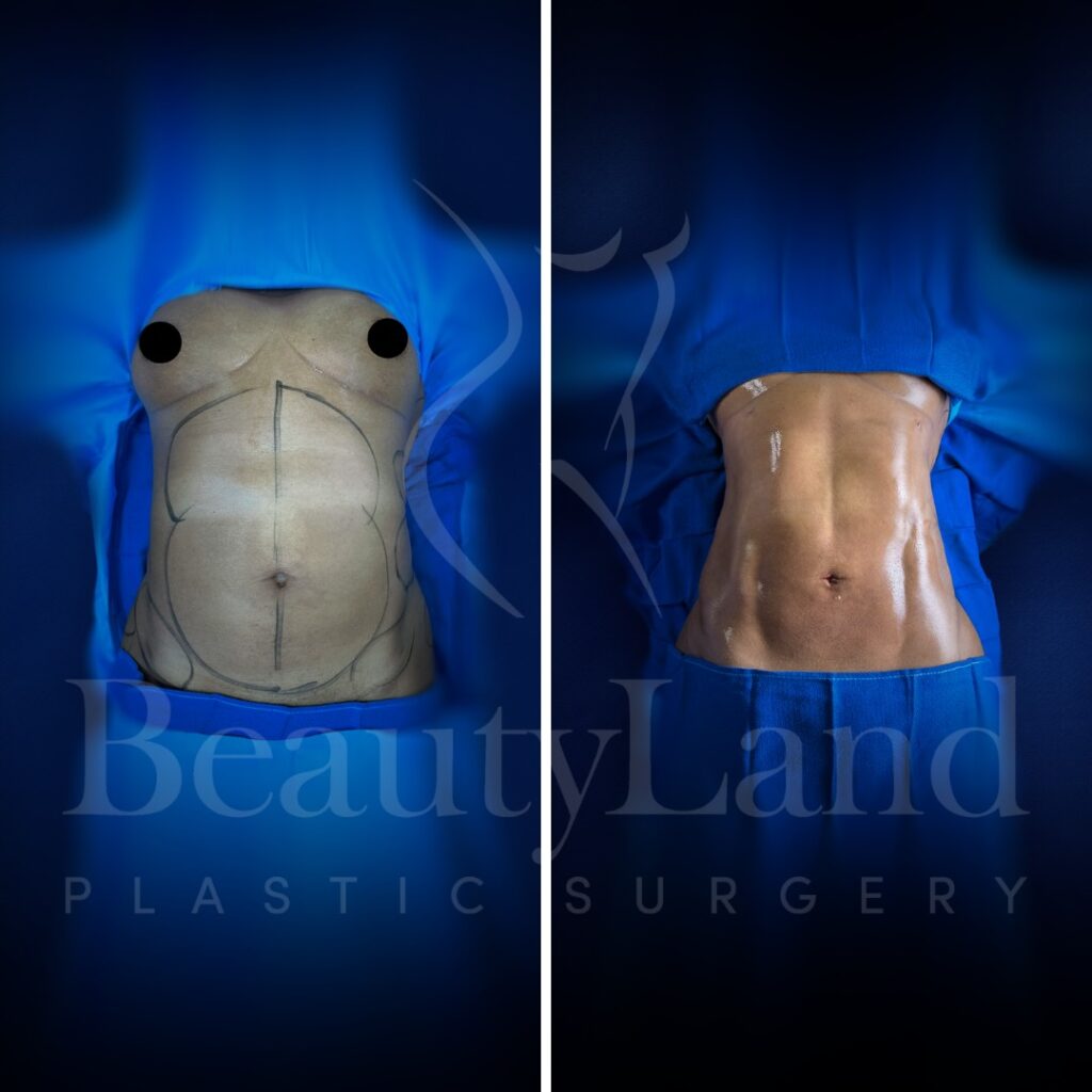 Liposuction