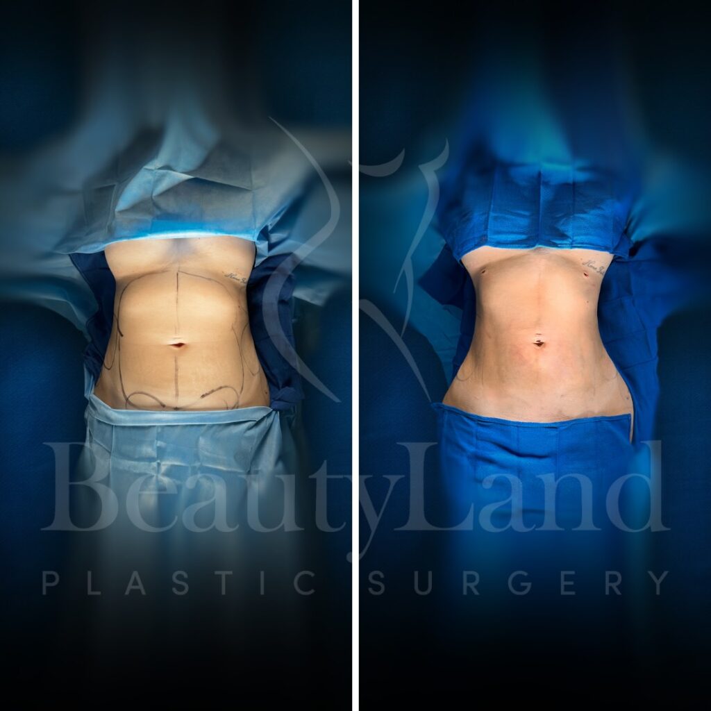 Liposuction