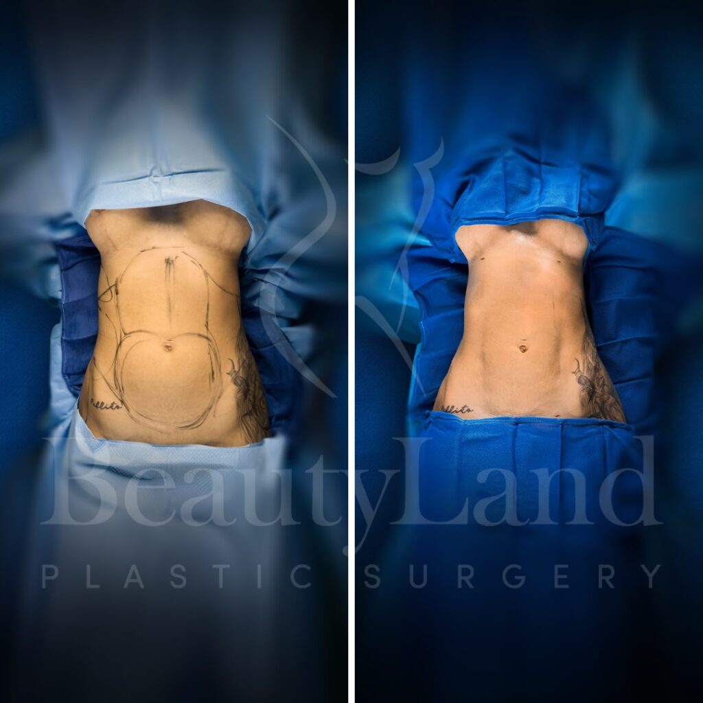 Liposuction