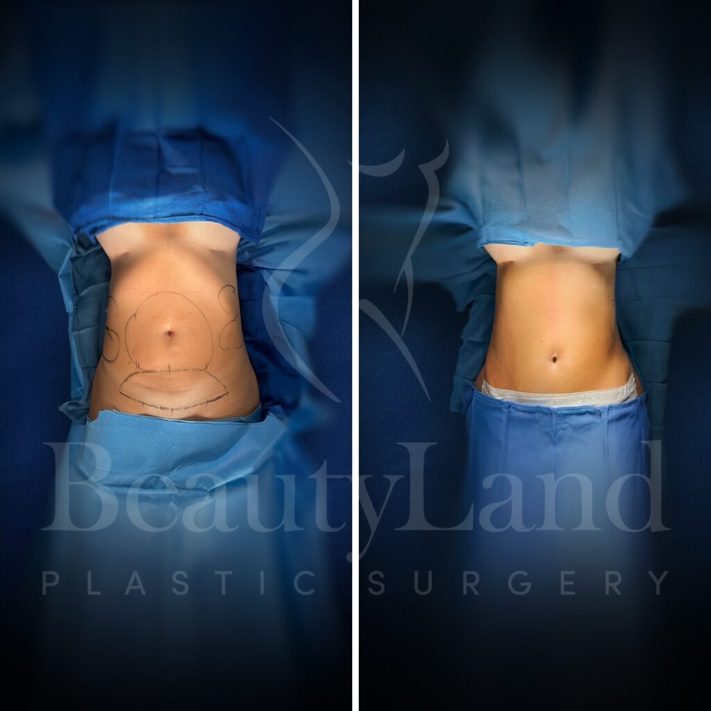 Tummy Tuck