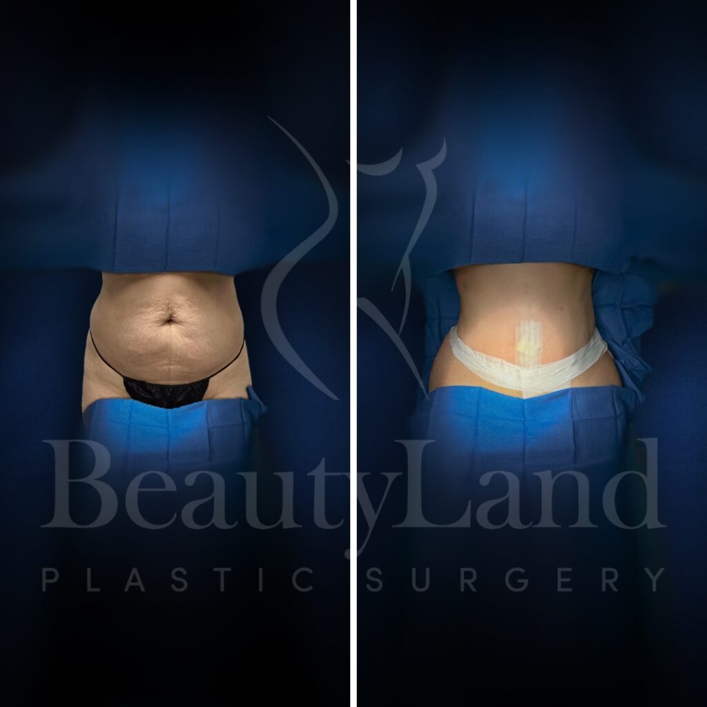 Tummy Tuck