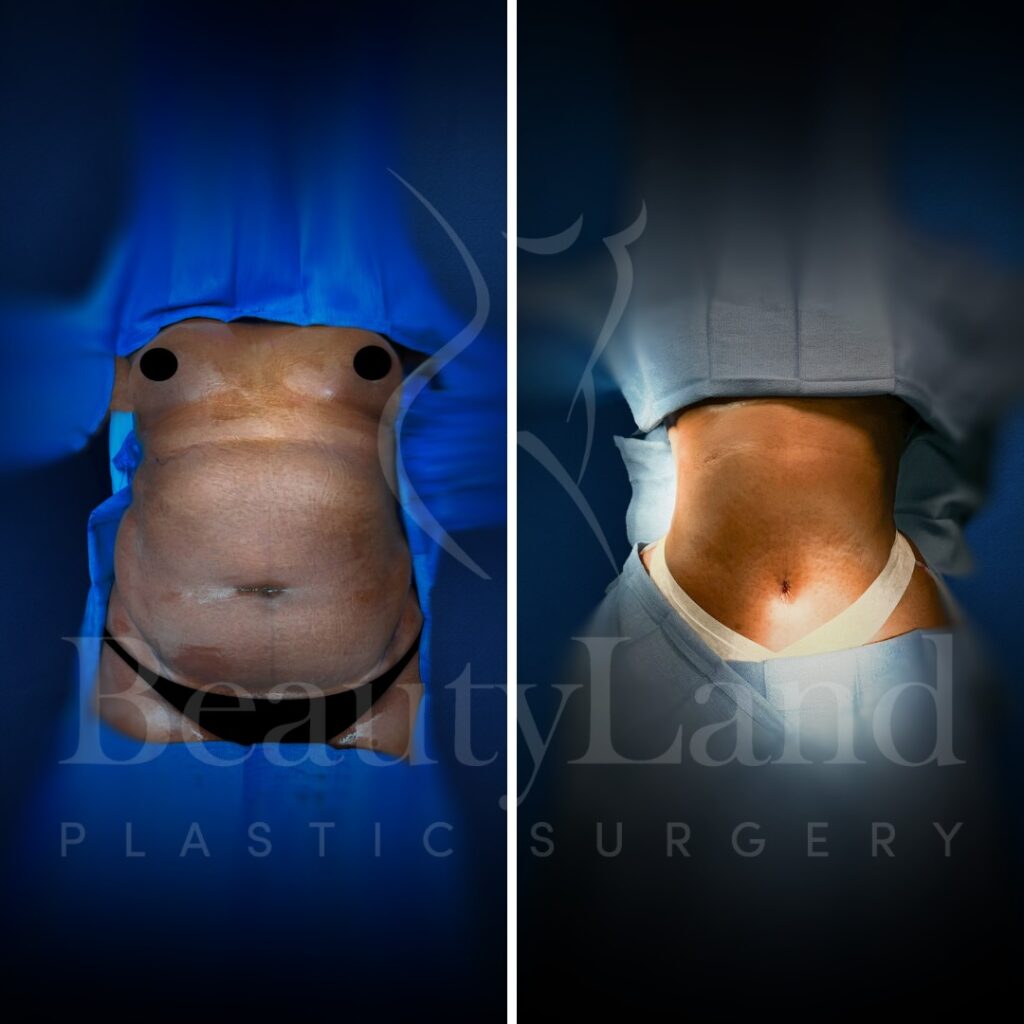 Tummy Tuck