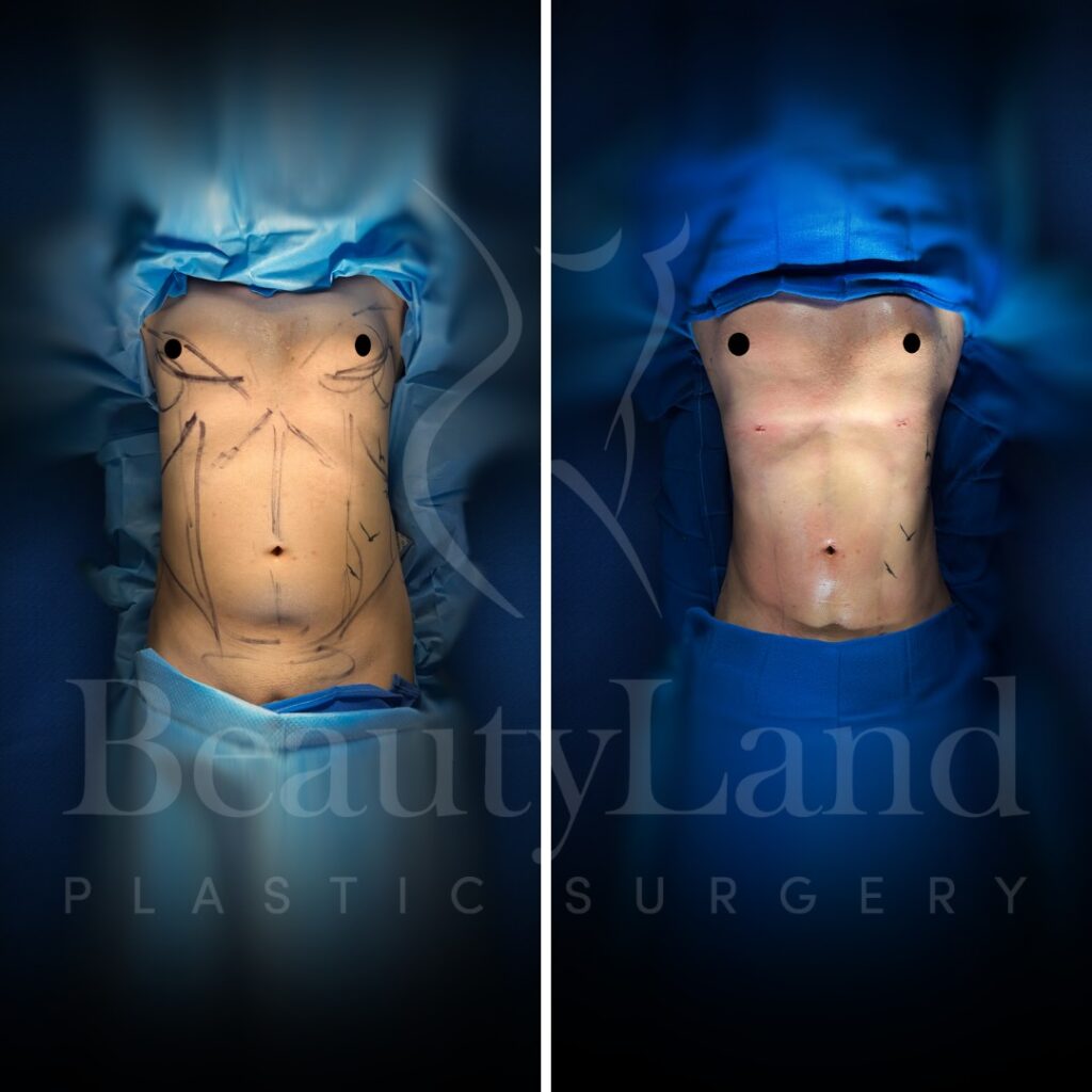 Liposuction