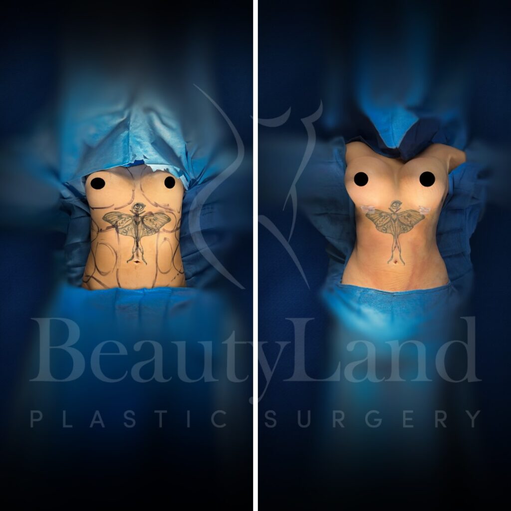 Breast Augmentation