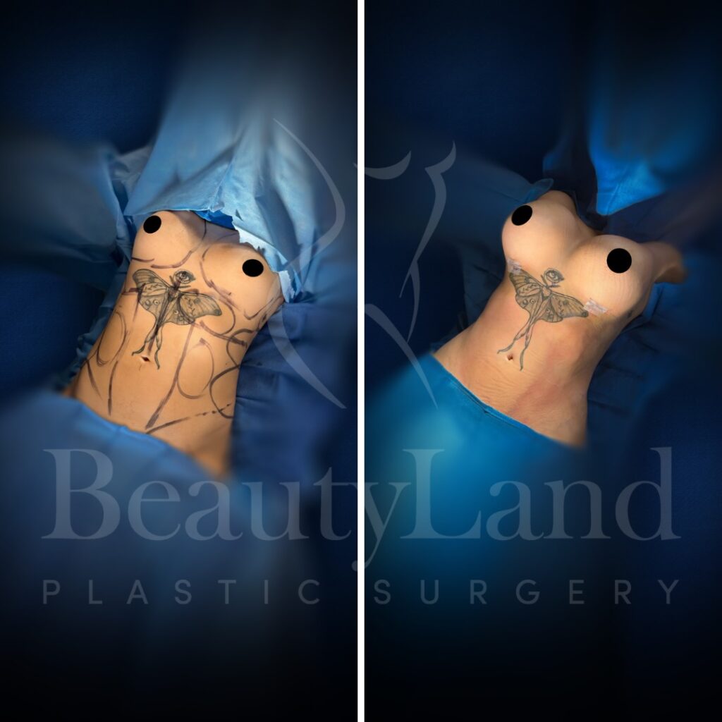 Breast Augmentation