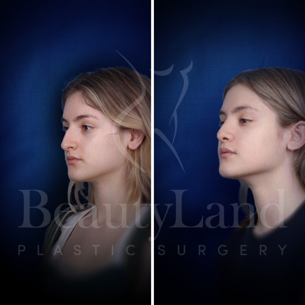 Rhinoplasty