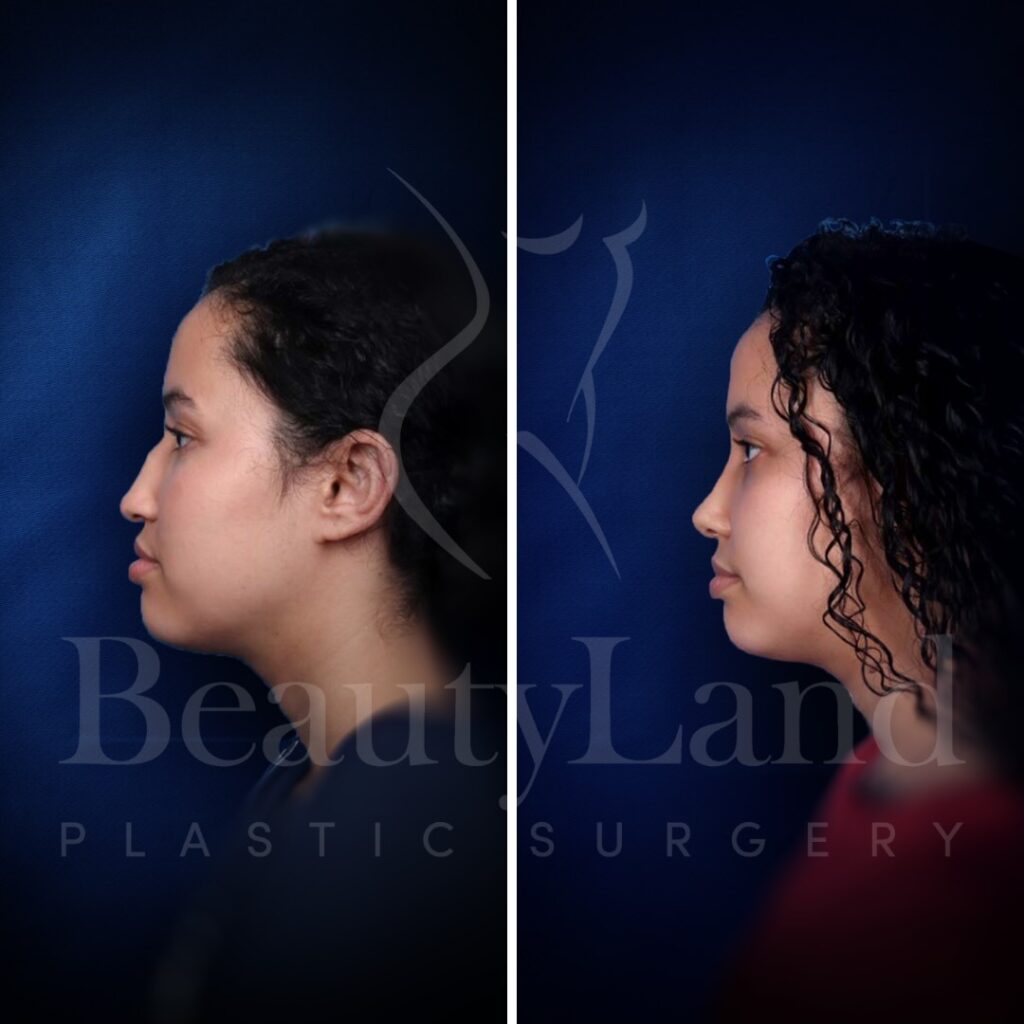 Rhinoplasty