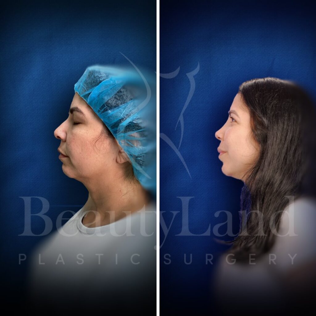 Rhinoplasty