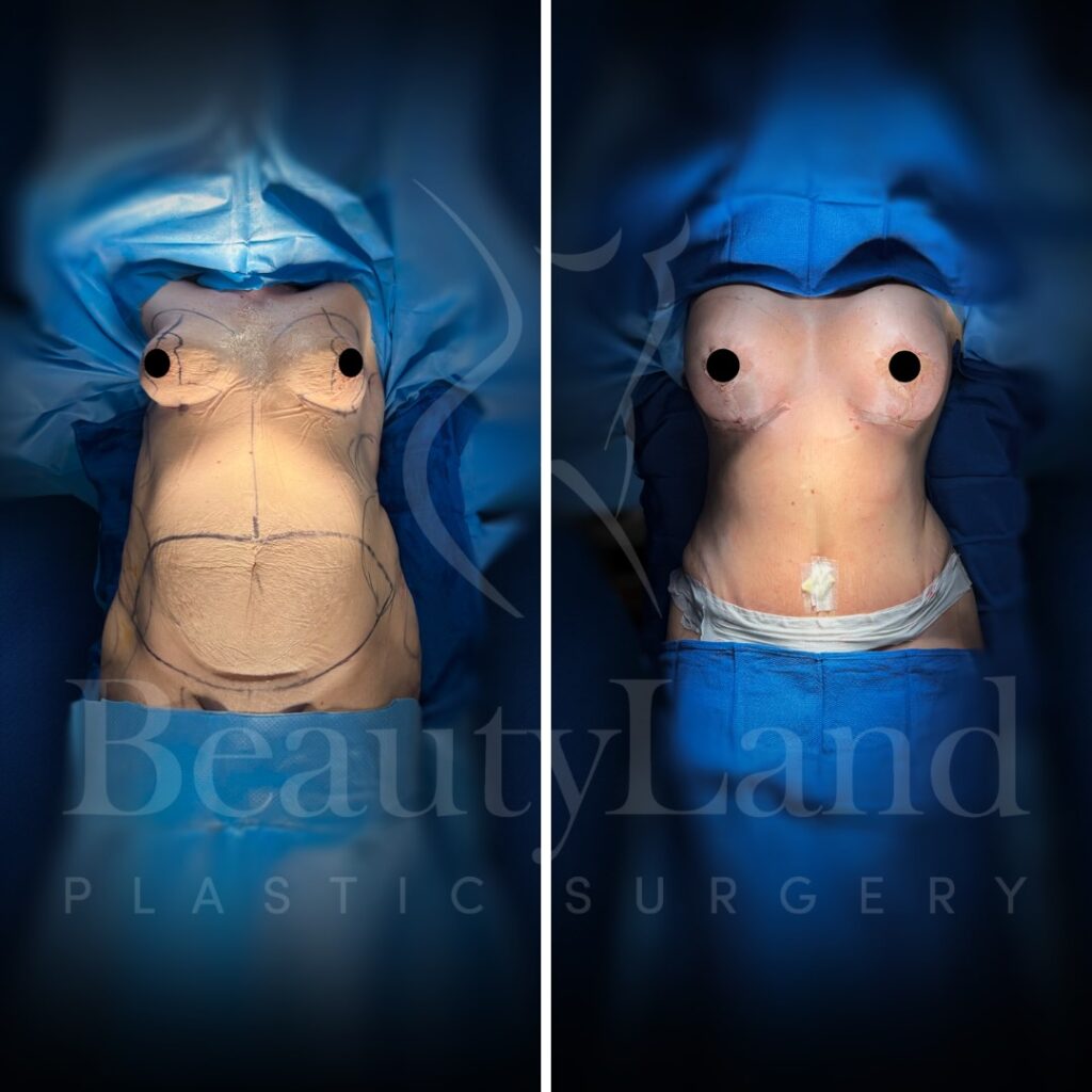 Breast Augmentation