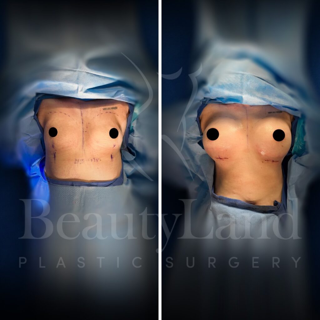 Breast Augmentation