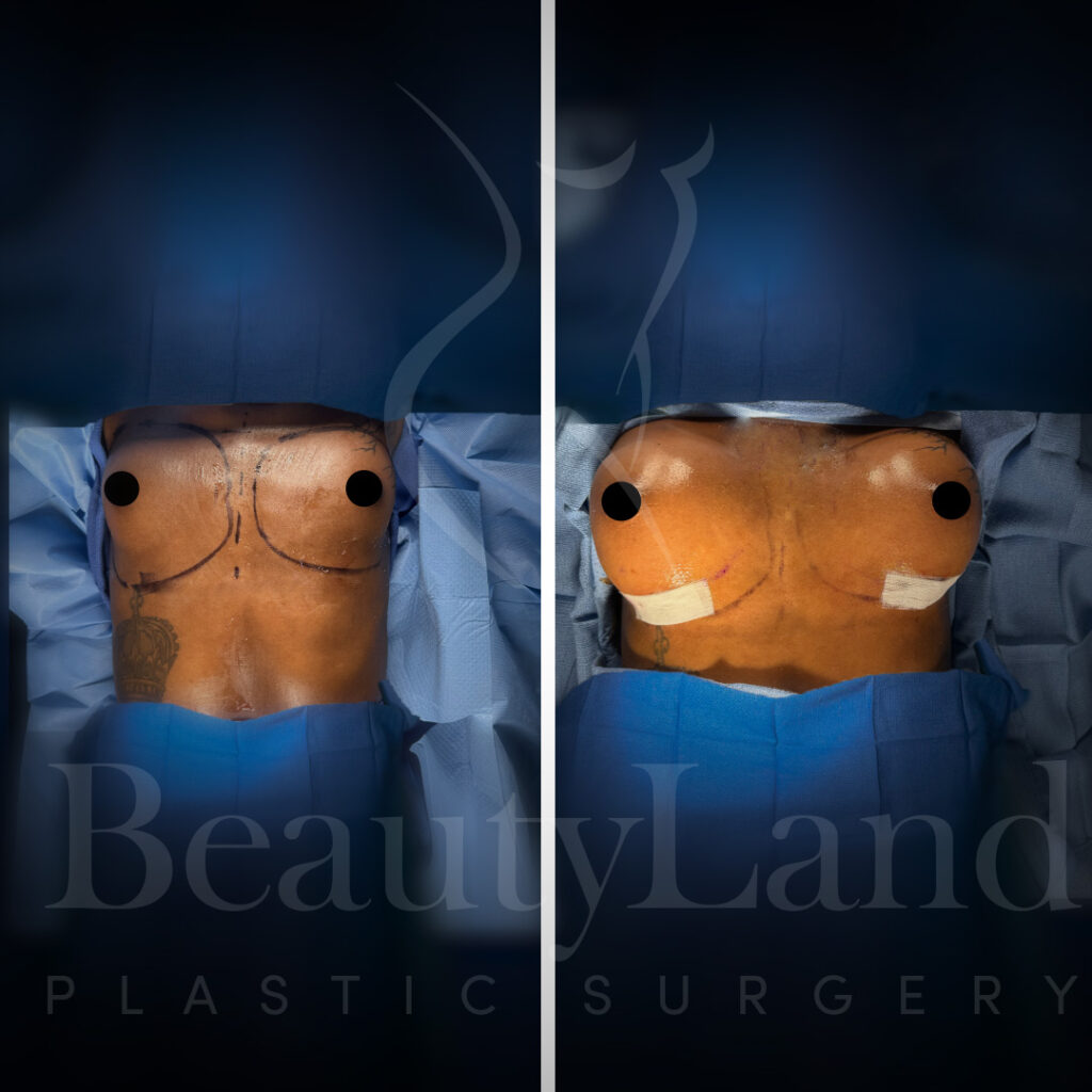 Breast Augmentation