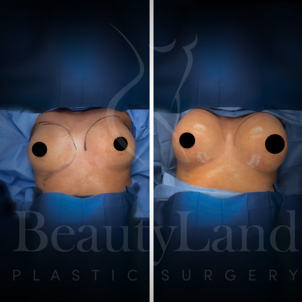 Breast Augmentation