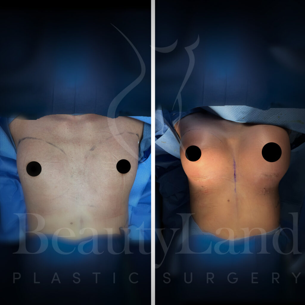 Breast Augmentation