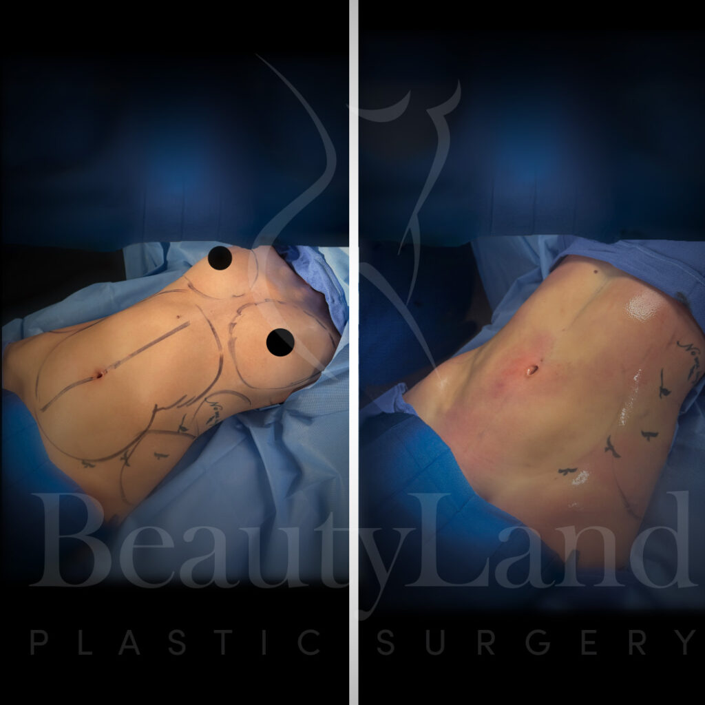 Liposuction